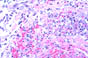 yx08Inflammation with necrosis .jpg (8191 bytes)