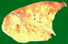 yx23.abscess formation lung.jpg (6708 bytes)